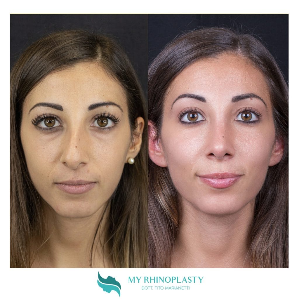 Come Stappare Il Naso Rimedi Efficaci Per Respirare Meglio • My