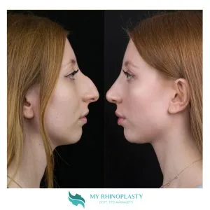 naso rifatto prima e dopo