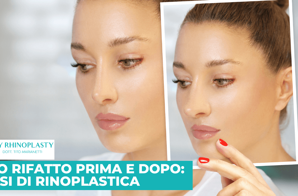 Naso rifatto prima e dopo