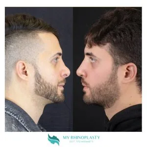 RInoplastica di revisione prima e dopo