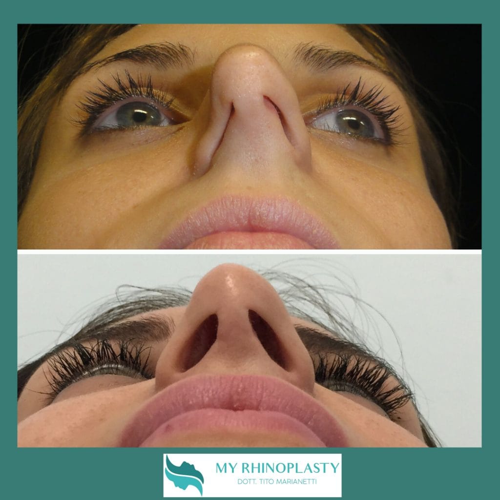 Setto Nasale Deviato Complicazioni E Soluzioni • My Rhinoplasty