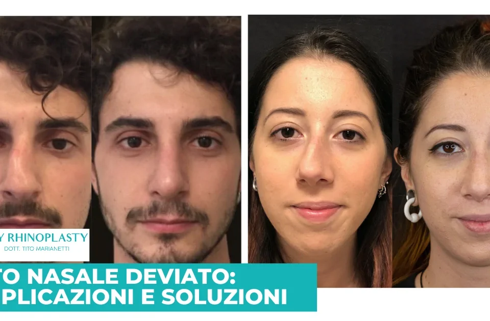 Setto nasale deviato