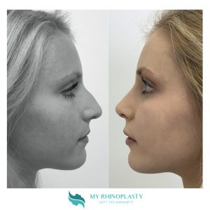 chirurgia plastica naso rinoplastica