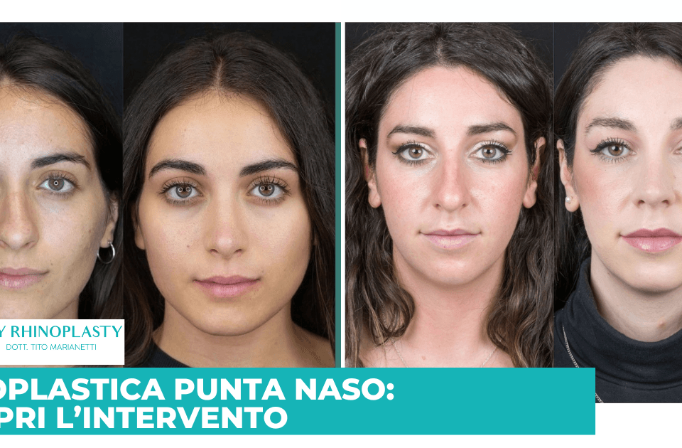 Rinoplastica Punta naso