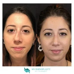 Rimodellamento del naso