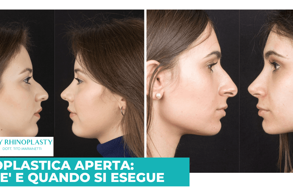 Rinoplastica Aperta