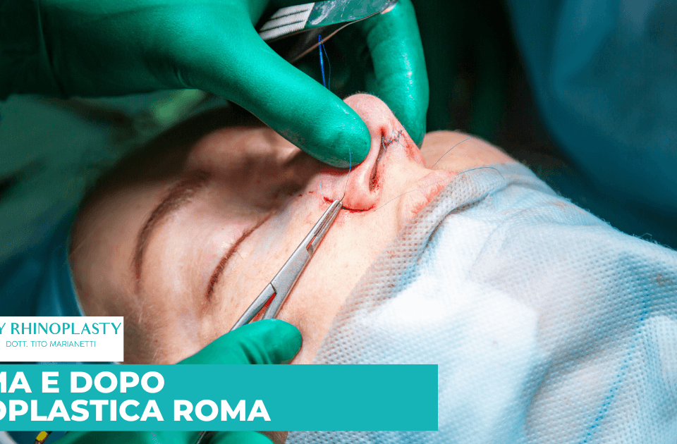 prima e dopo rinoplastica roma