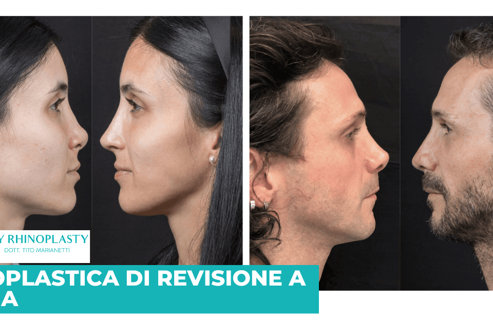 Rinoplastica di revisione Roma