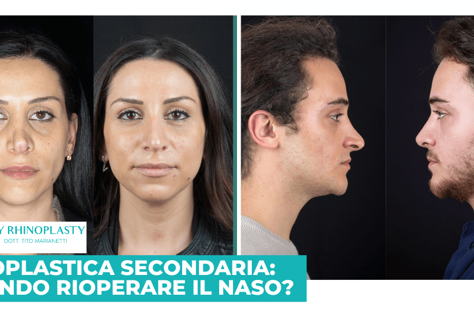 Rinoplastica secondaria
