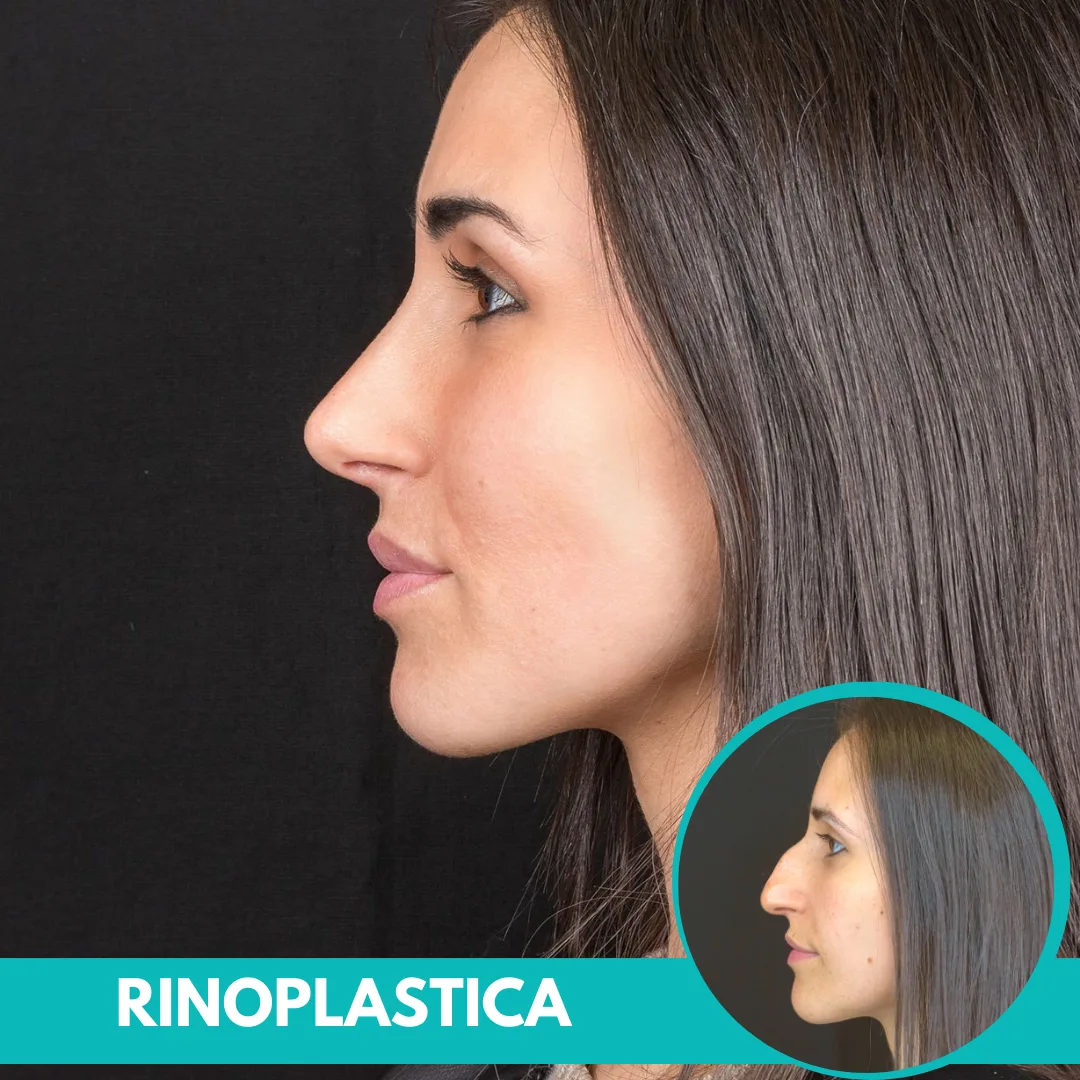 Rinoplastica prima e dopo