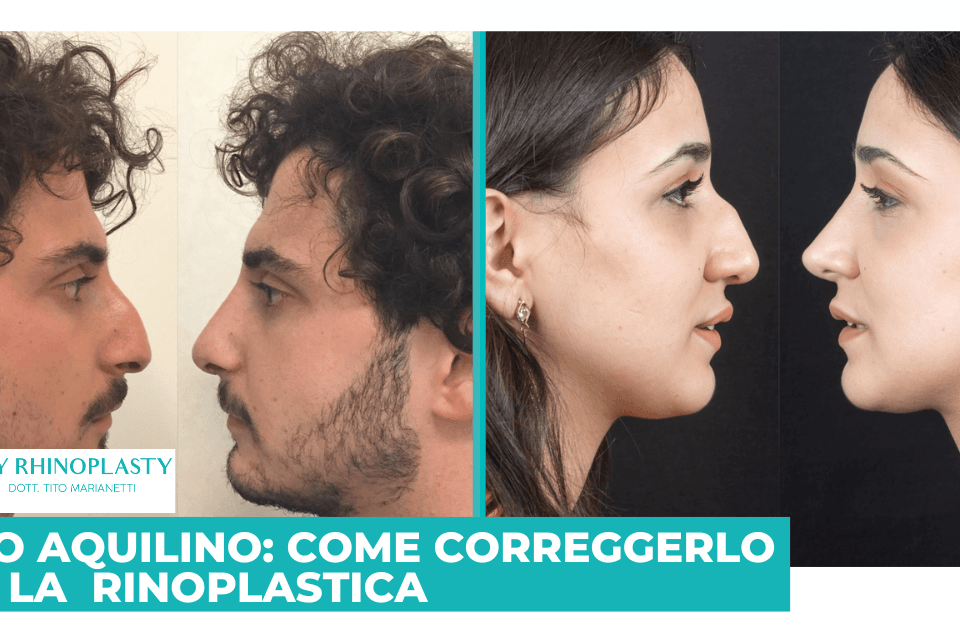 Naso Aquilino, rinoplastica