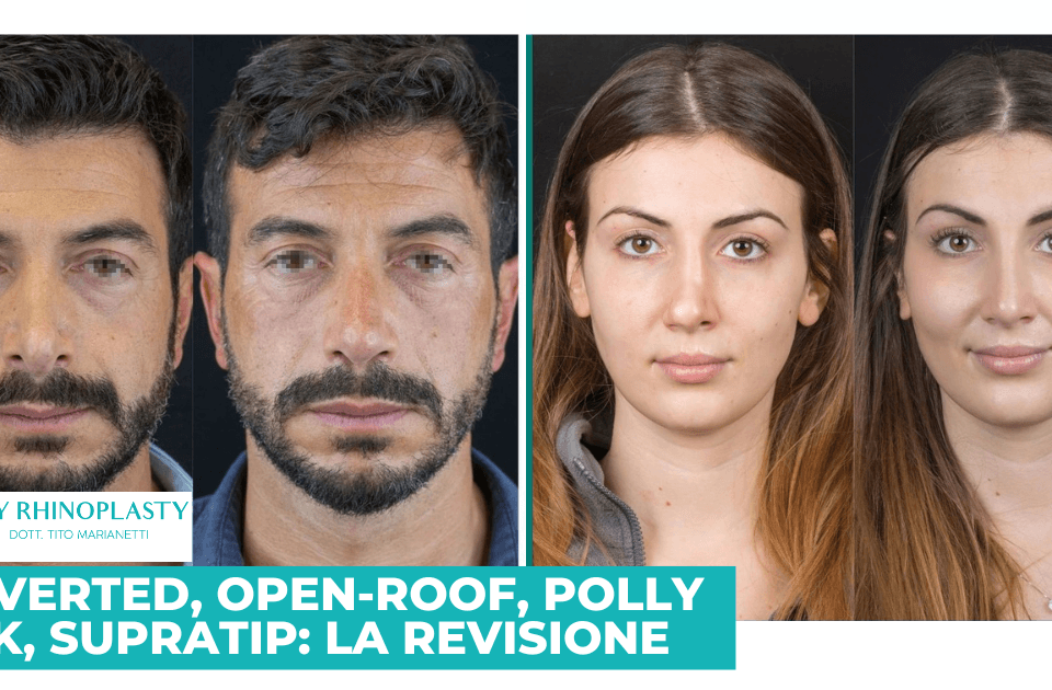 V-inverted; oper-roof, Polly beak, supratip, rinoplastica di revisione