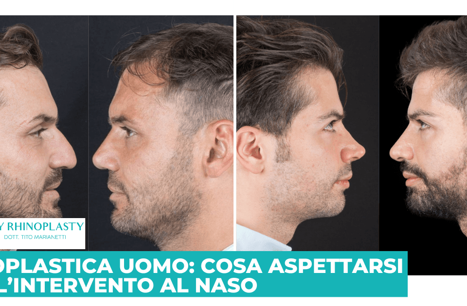 Rinoplastica uomo; Rinoplastica maschile