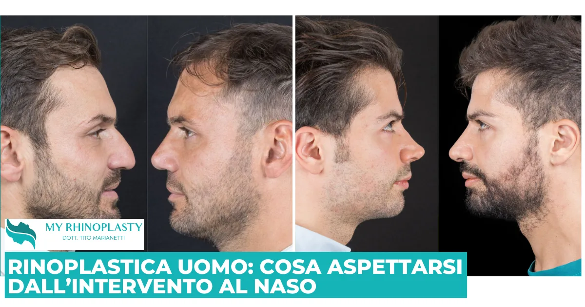 Rinoplastica uomo; Rinoplastica maschile