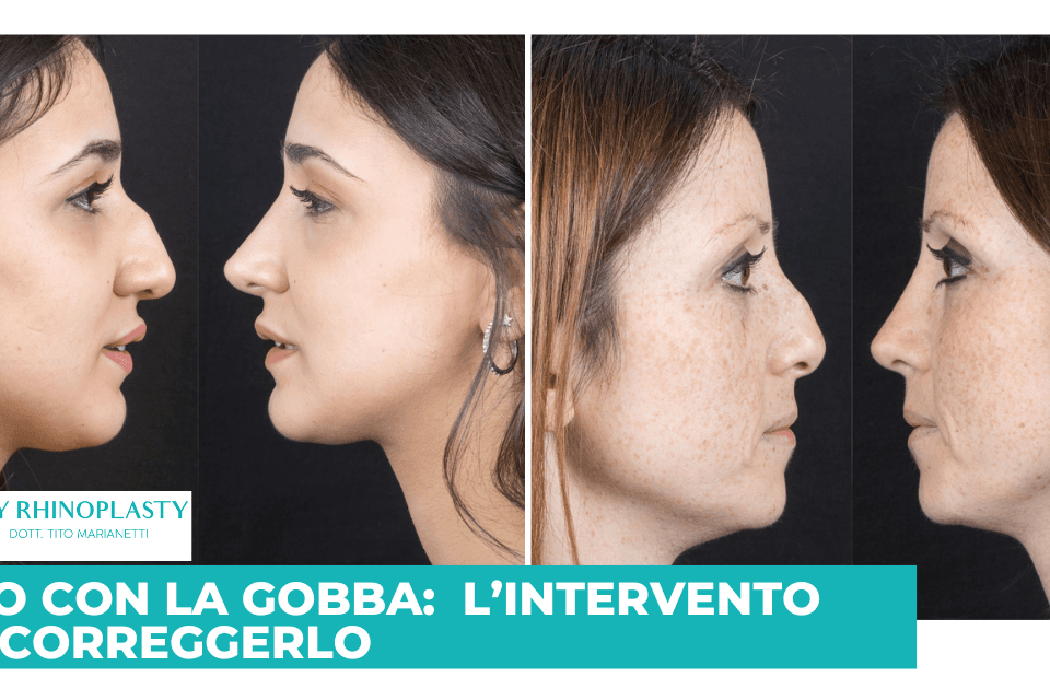 Naso con la gobba, rinoplastica, rinosettoplastica, gibbo nasale