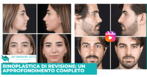 Rinoplastica di revisione