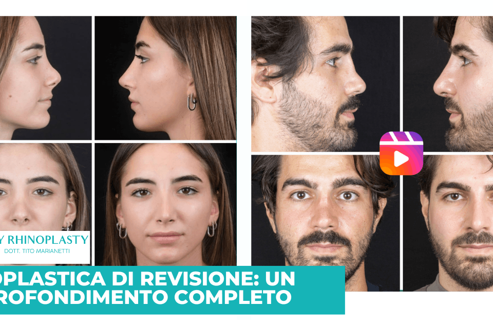 Rinoplastica di revisione