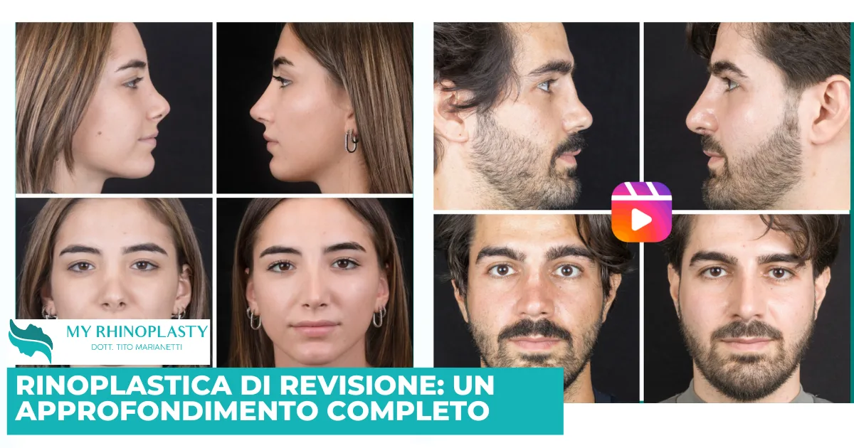 Rinoplastica di revisione