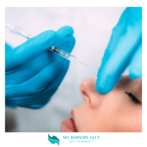 Rinofiller naso - Rinoplastica non chirurgica