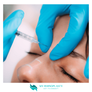 Rinofiller 2 - Rinoplastica liquida