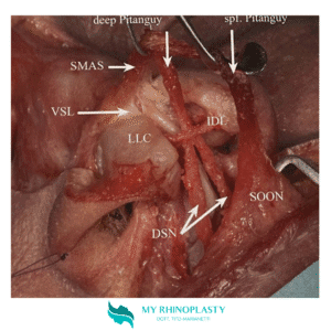 Legamento Interalare; pitanguy ligament; Interalar Ligament Flap