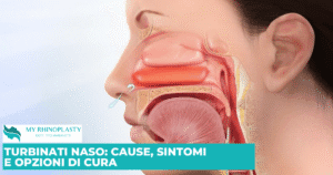 Turbinati Naso, ipertrofia dei turbinati, turbinati nasali, turbinati ipertrofici