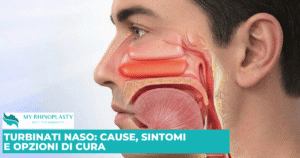 Turbinati Naso, Ipertrofia dei turbinati, turbinati ipertrofici