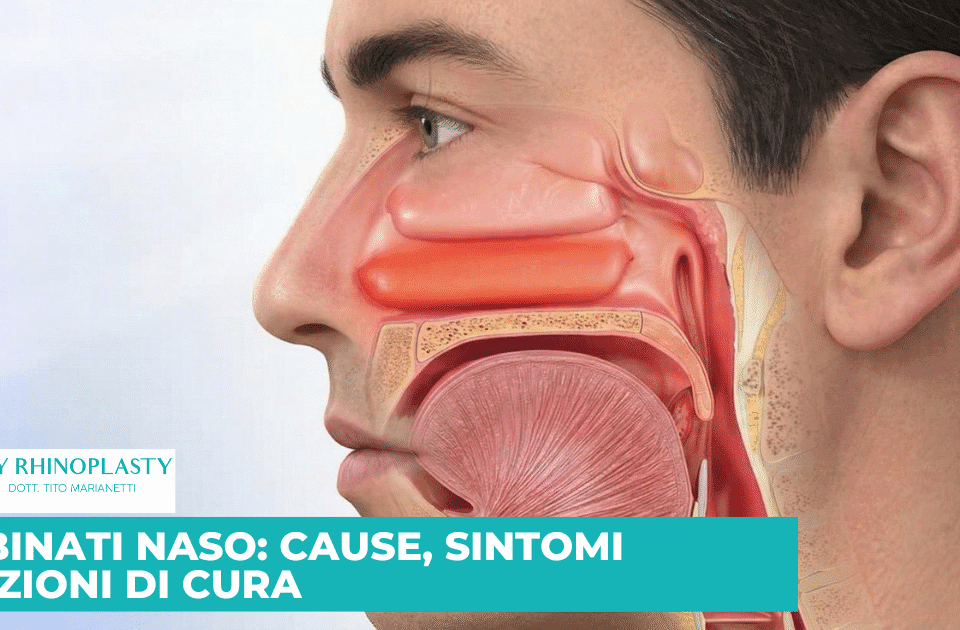 Turbinati Naso, Ipertrofia dei turbinati, turbinati ipertrofici