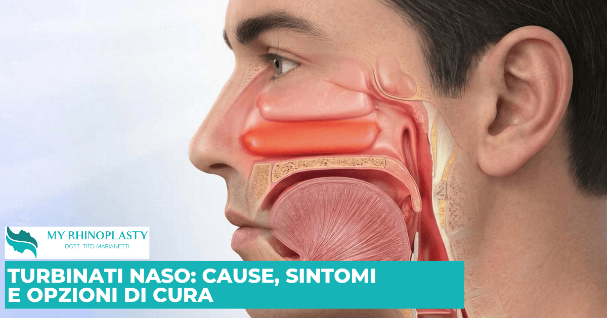 Turbinati Naso, Ipertrofia dei turbinati, turbinati ipertrofici