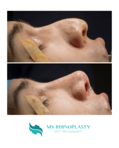 Rinoplastica Testimonianze