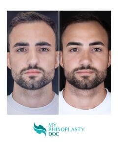 Testimonianze Rinoplastica Tito Marianetti