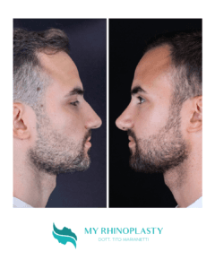 Testimonianza Rinoplastica Tito Marianetti