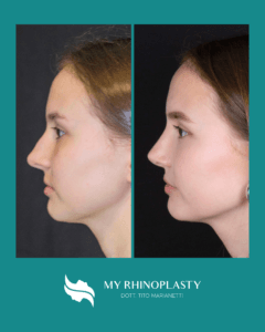 testimonianze rinoplastica