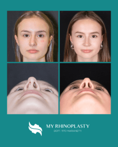 testimonianze rinoplastica tito marianetti