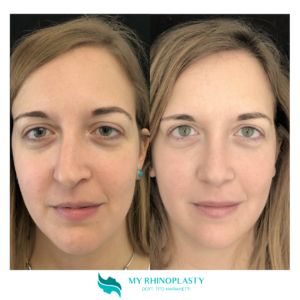 preservation rhinoplasty