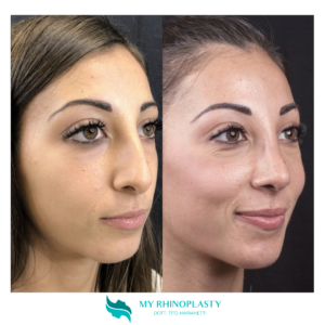 Preservation rhinoplasty