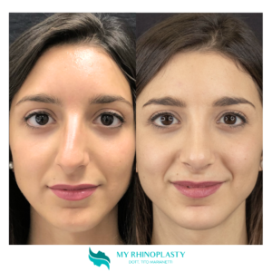 preservation rhinoplasty