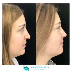 rinoplastica di preservazione, preservation rhinoplasty
