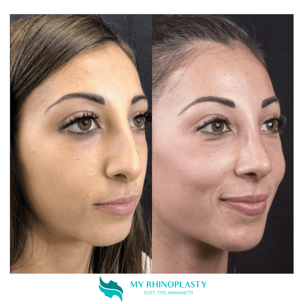 Preservation rhinoplasty