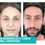 Preservation Rhinoplasty: cos’è, come funziona e quali sono i vantaggi