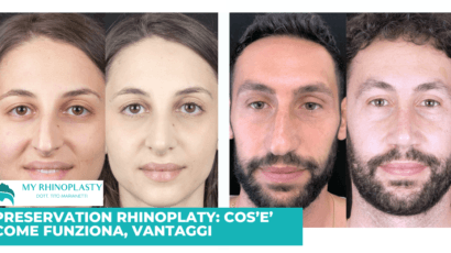 Preservation rhinoplasty