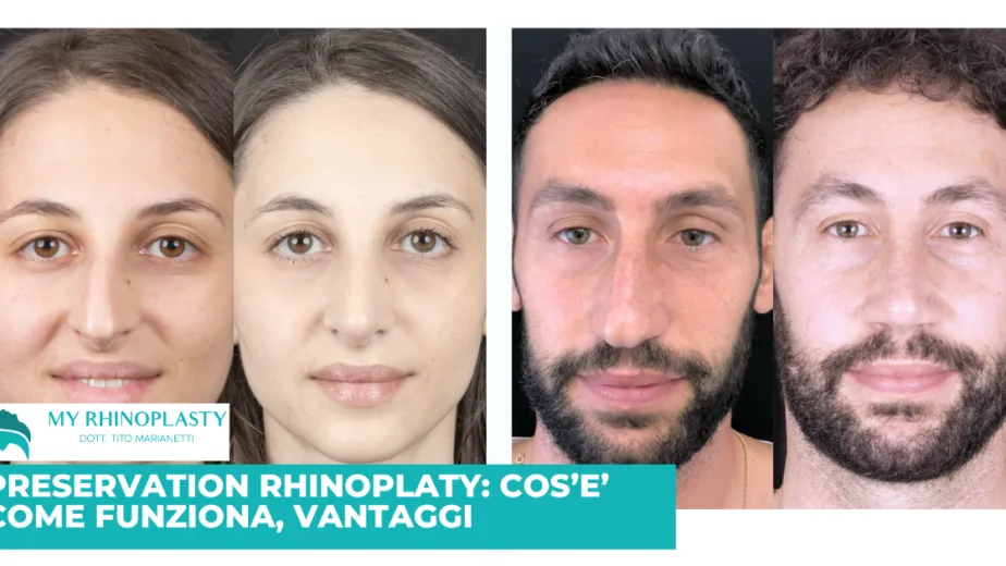 Preservation rhinoplasty