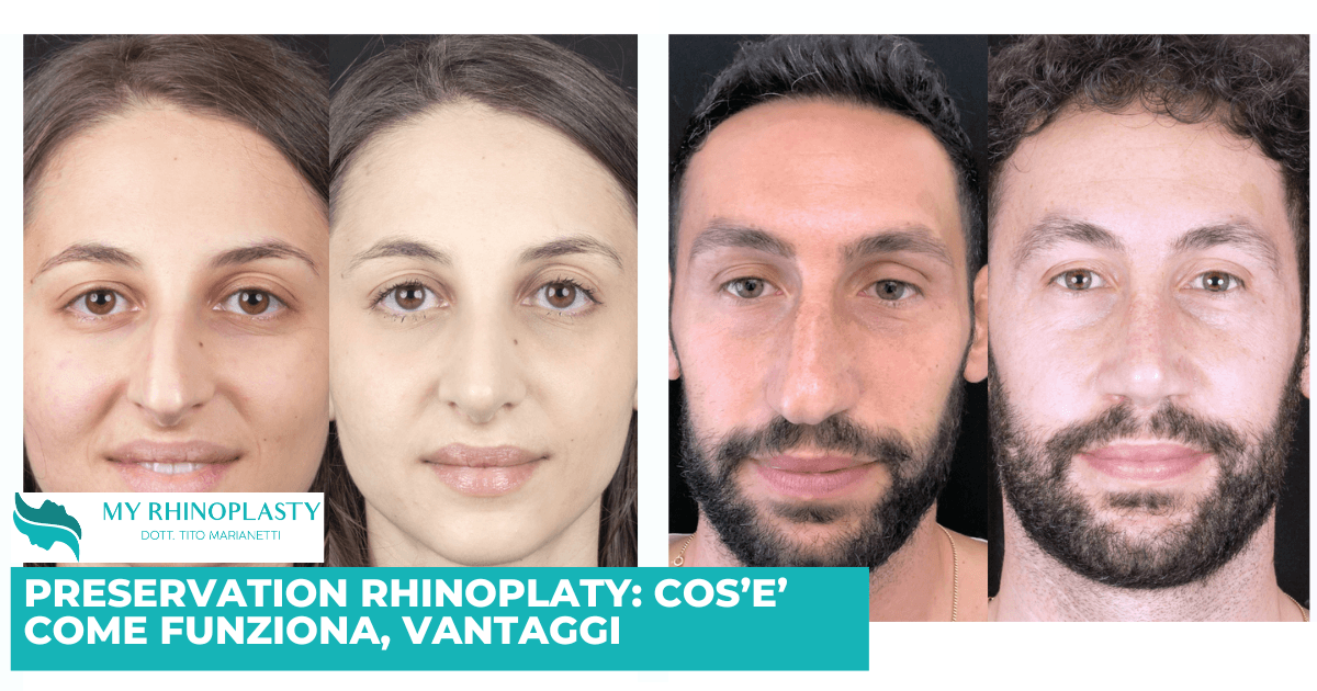 Preservation rhinoplasty