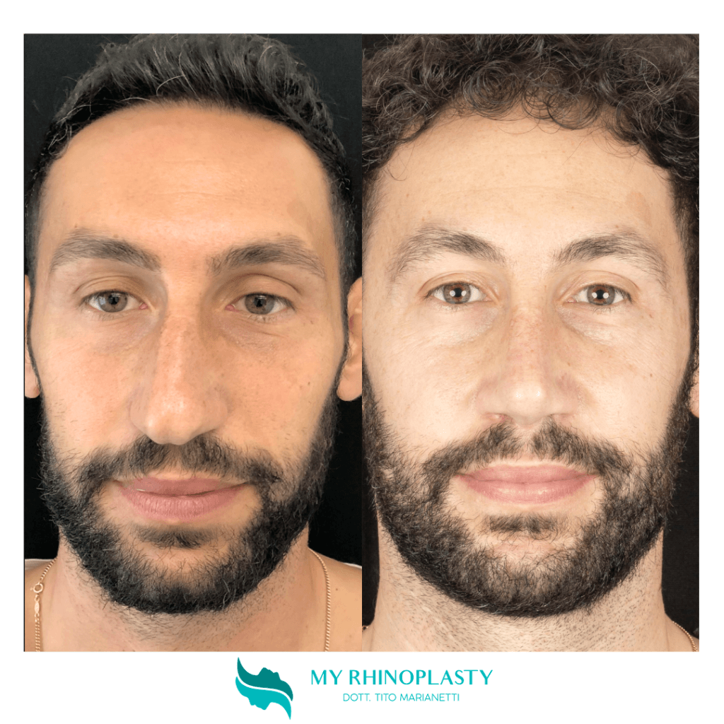 preservation rhinoplasty