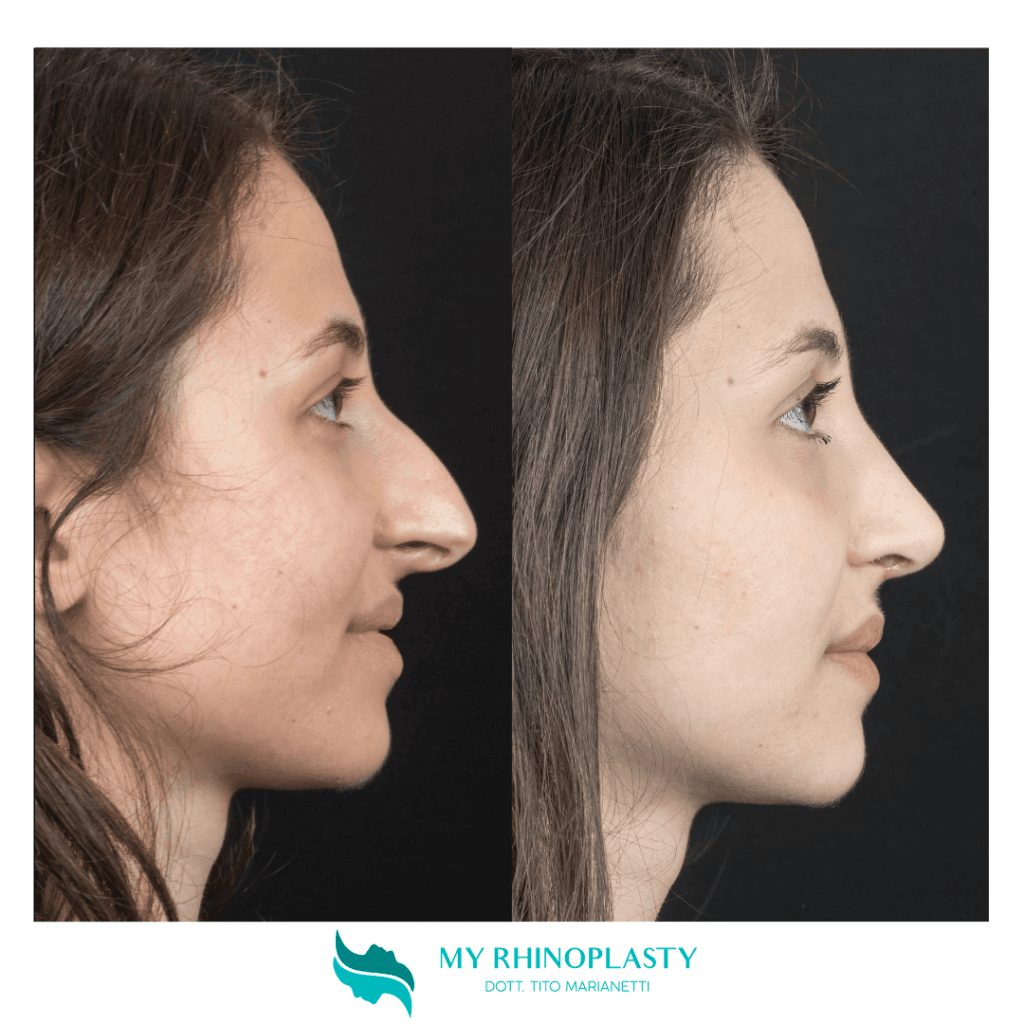Preservation rhinoplasty