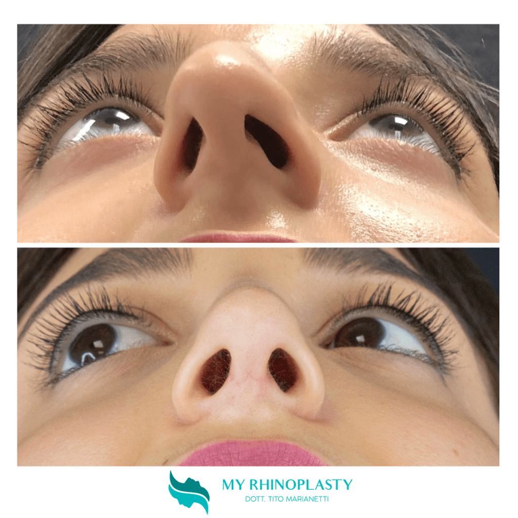 preservation rhinoplasty
