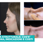 Rinoplastica strutturale: cos’è, come funziona, indicazioni e costi