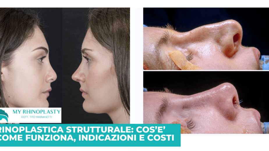 Rinoplastica strutturale Cover