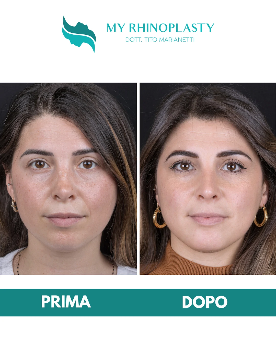 Rinoplastica-di-revisione-1-Annarita