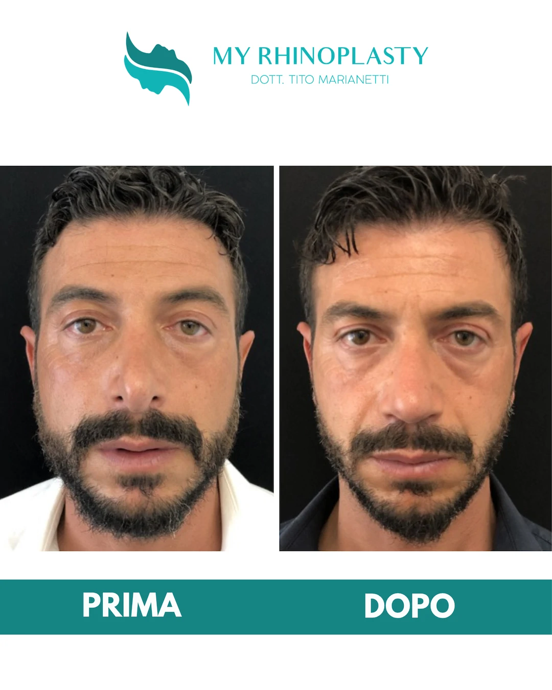 Rinoplastica-di-revisione-1-Cara